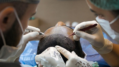 Hair transplant FUE technique — surgeons at work