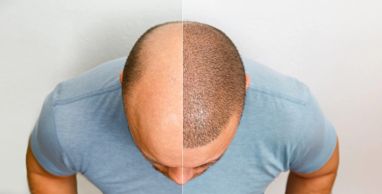 Hair transplant permanent result