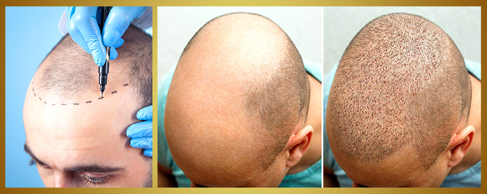 Hair transplant side effects