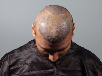 Lucknow hair transplant after surgery photo