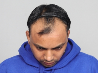 Chandigarh hair transplant before surgery photo