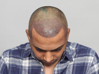 Chandigarh hair transplant after surgery photo