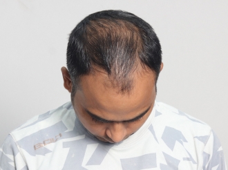 Indore hair transplant before surgery photo