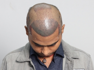 Indore hair transplant after surgery photo