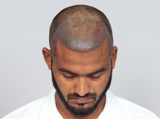 Bangalore hair transplant after surgery photo