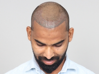 Hyderabad hair transplant after surgery photo