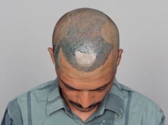 Ahmedabad hair transplant after surgery photo