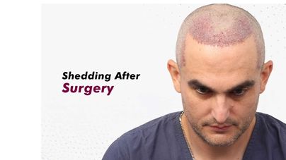 Hair transplant month by month timeline