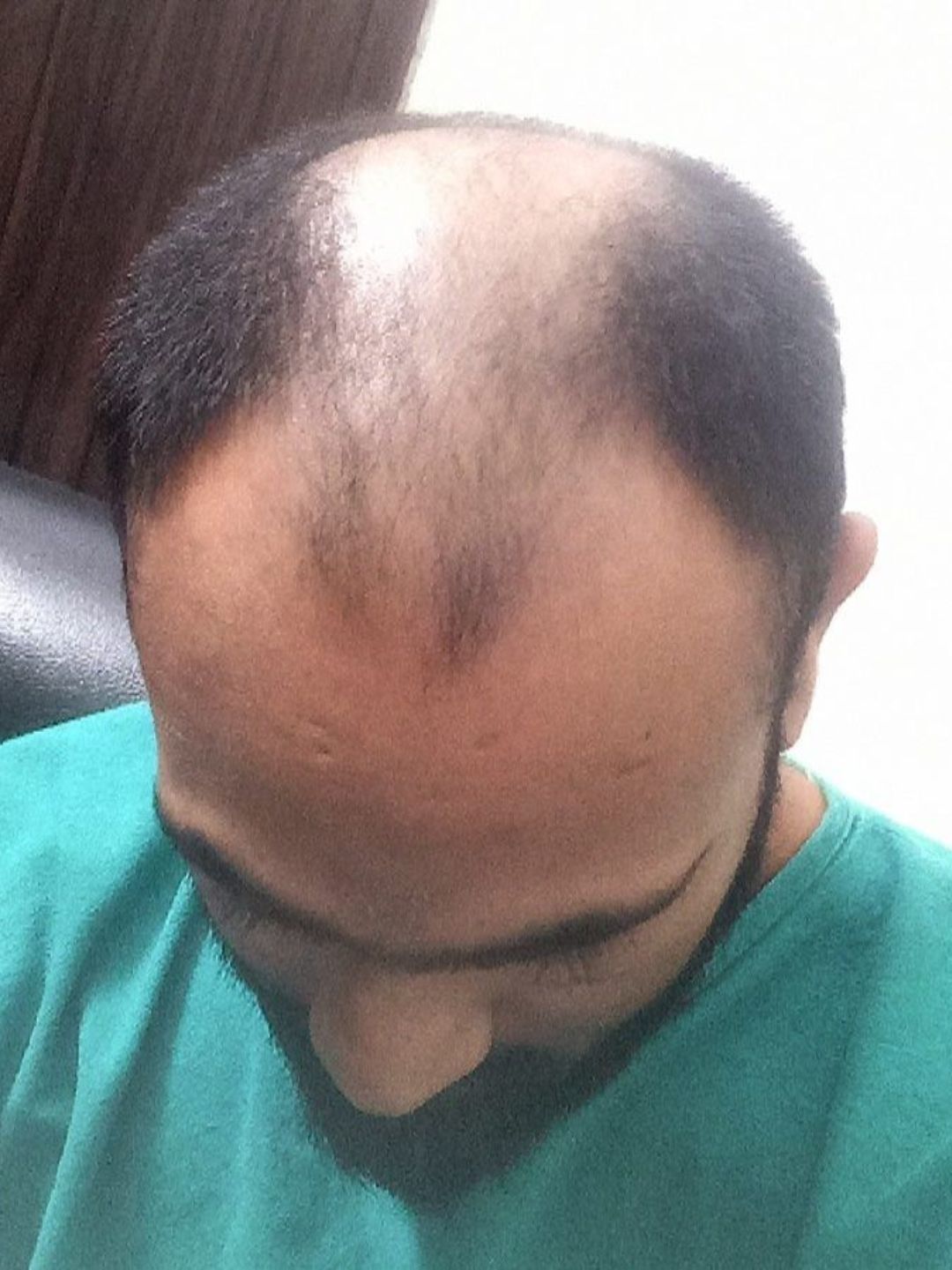 Before the procedure